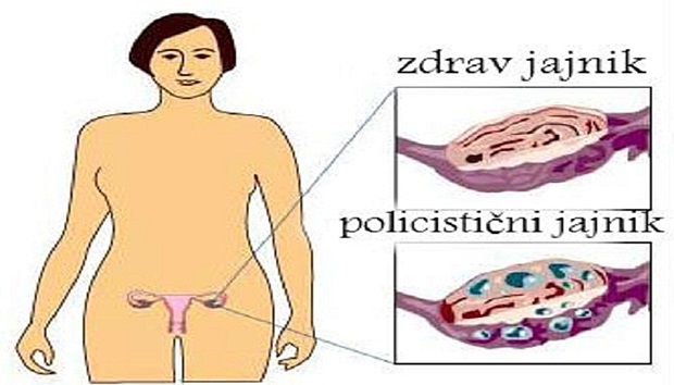 Image result for PRIRODNI RECEPT ZA UPALU JAJNIKA: Liječi čak i tamo gdje su antibiotici nemoćni!